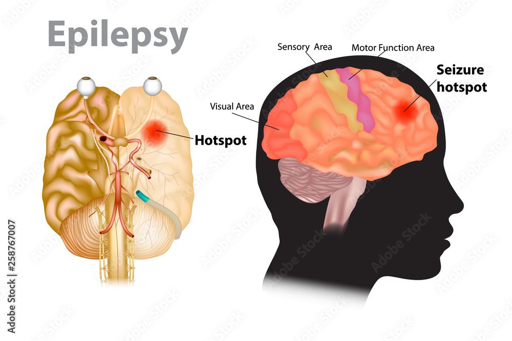 Epilepsy
