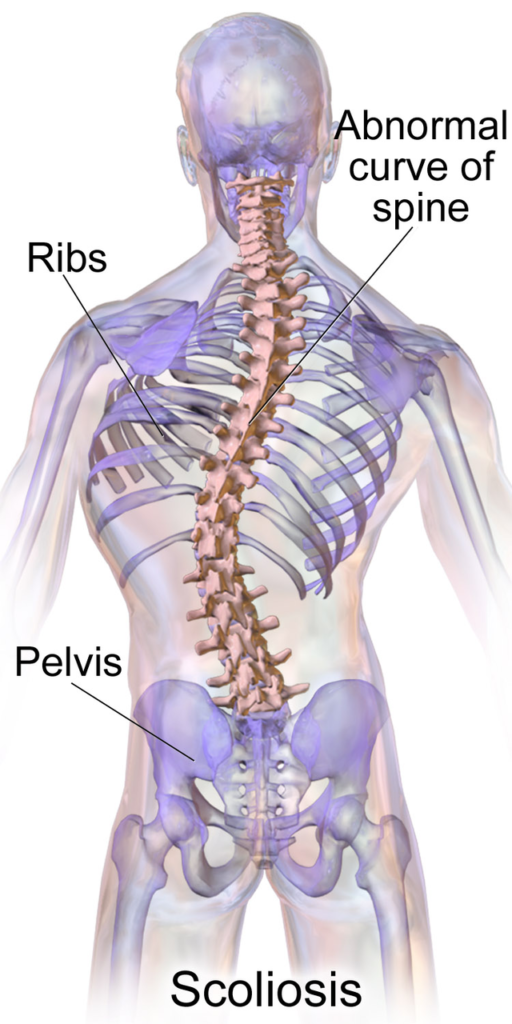 Scoliosis
