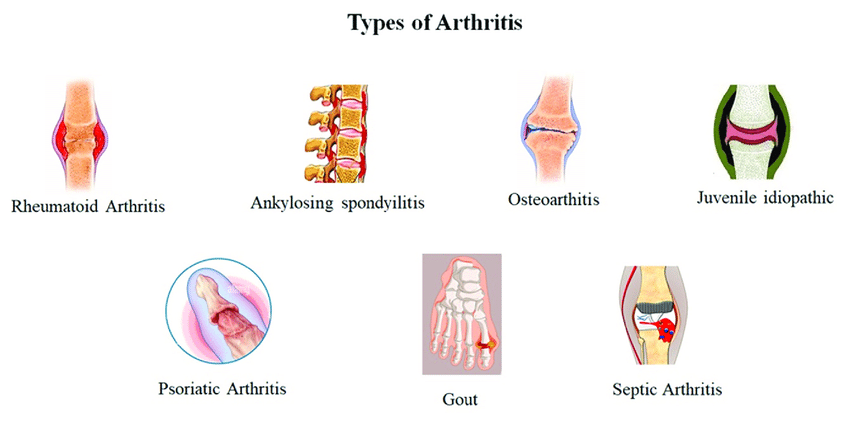 Different Types of Arthritis
