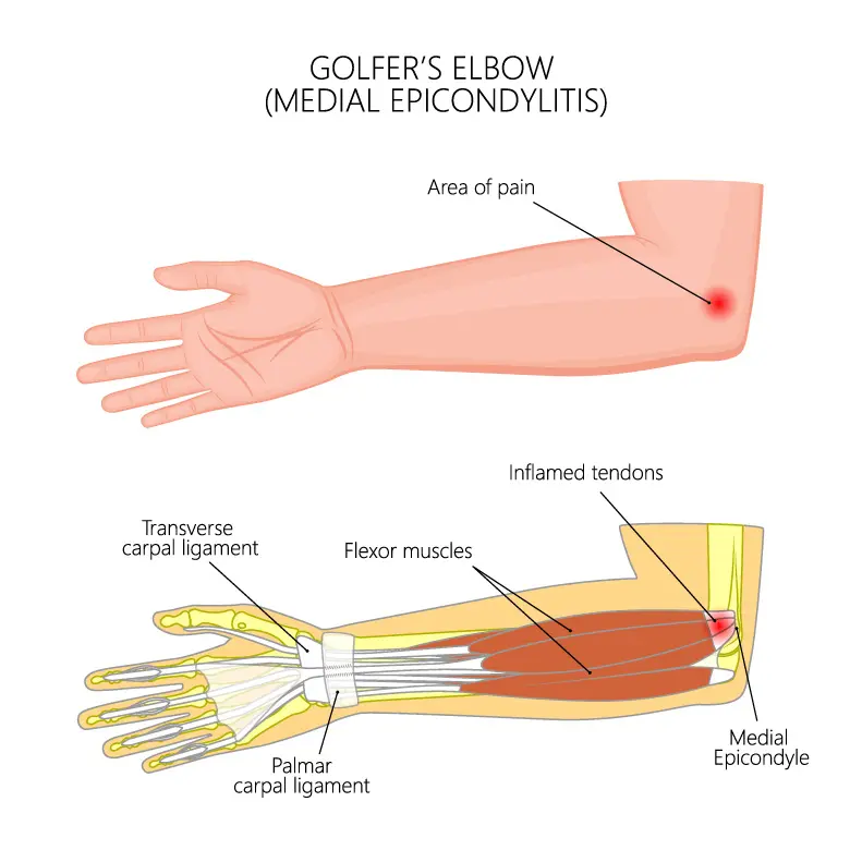 Golfer’s Elbow