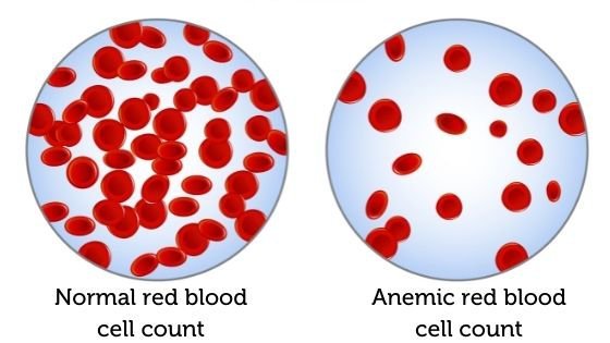 Anemia
