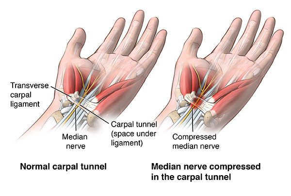 Carpal Tunnel Syndrome 
