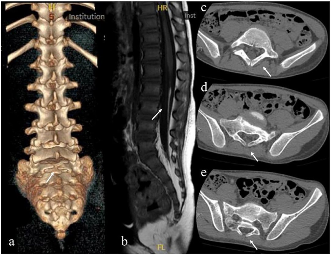 Spina Bifida