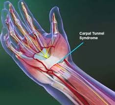 Carpal Tunnel Syndrome