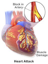 Myocardial Infarction