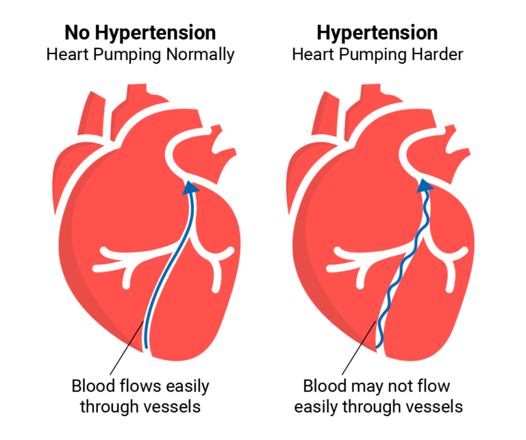 high blood pressure
