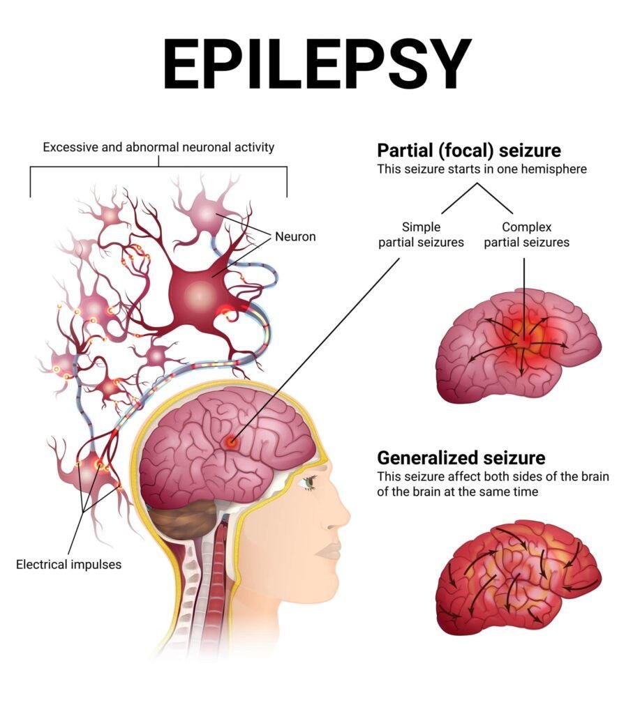 Seizures Types