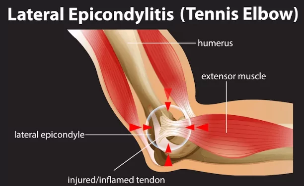 Tennis Elbow